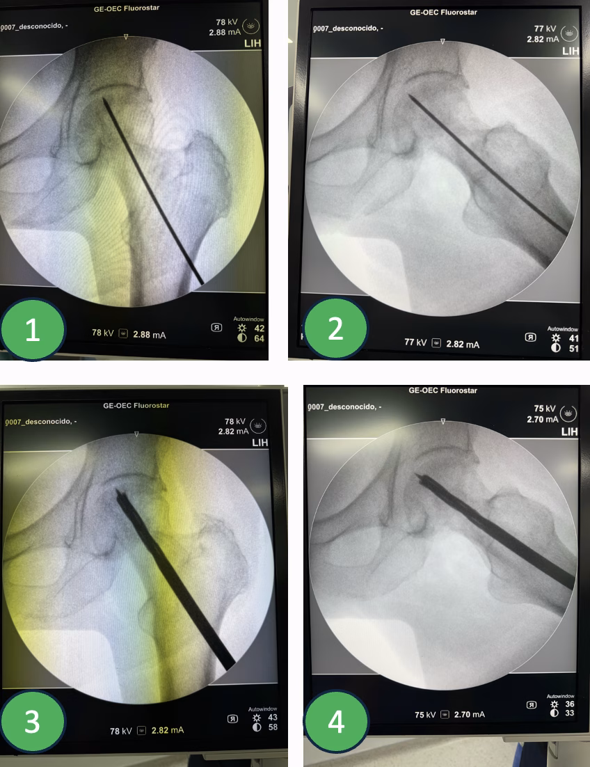 Descompresión de cabeza femoral — Imagen ilustrativa del procedimiento